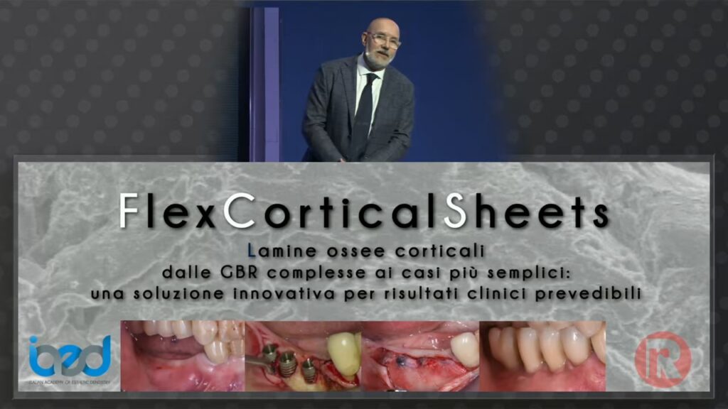 Applicazione delle lamine ossee corticali Flex-Cortical Sheets dalle GBR complesse ai casi più semplici: una soluzione innovativ